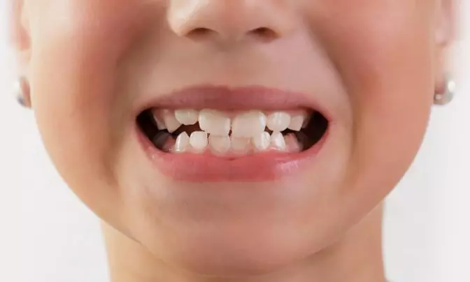 Аномалии прикуса: что следует знать об ортодонтии