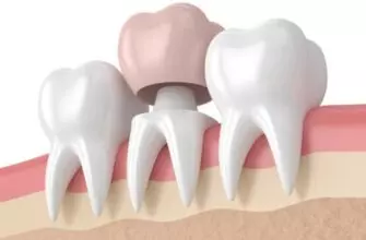 Металлокерамические коронки на зуб