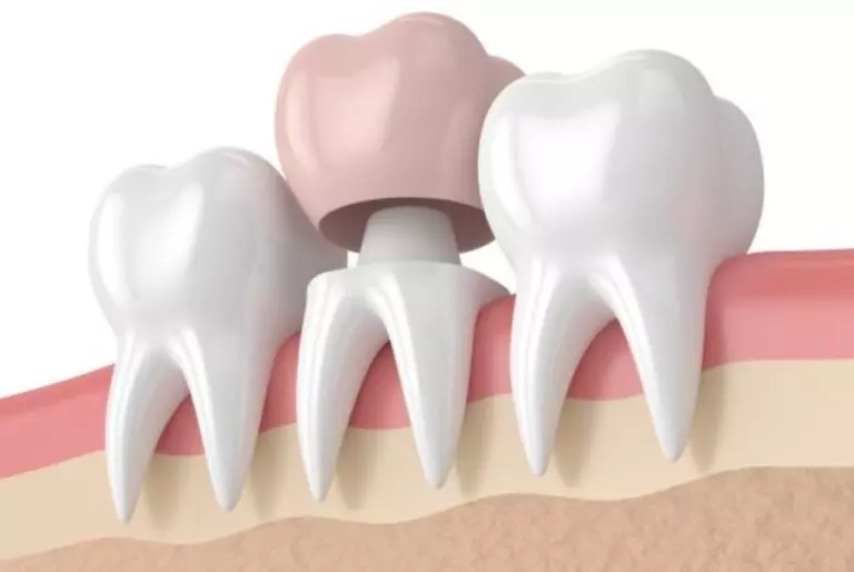 Металлокерамические коронки на зуб